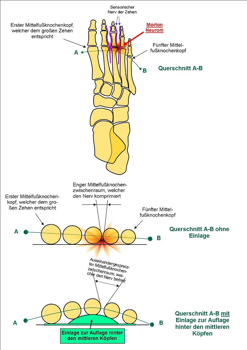 Pathologien > Morton-Krankheit Oder Morton Neurom